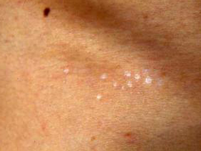 斑萎缩又称斑状萎缩性皮炎.是皮肤发生弹性消失而松弛的卵圆形萎缩斑.