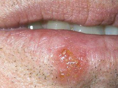 单纯性疱疹亦称为发热性水疱,是由单纯疱疹病毒所致的疼痛性感染,他