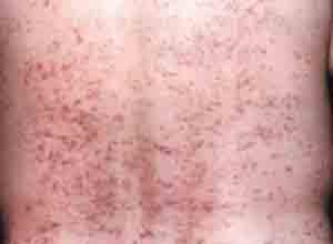 条纹状苔藓,条纹状苔藓如何治疗,条纹状苔藓症状-皮肤性病科-皮肤科