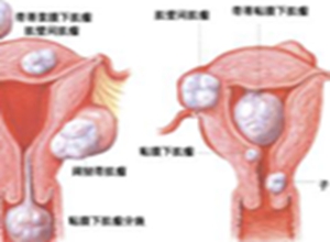 子宫内膜结核
