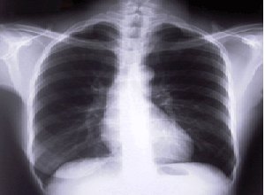 什么是肺气肿