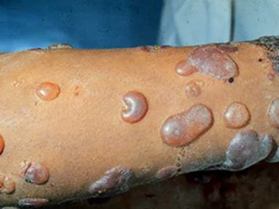 表皮内嗜中性iga皮肤病是1985年由huff等报道一种成年男性的慢性大疱