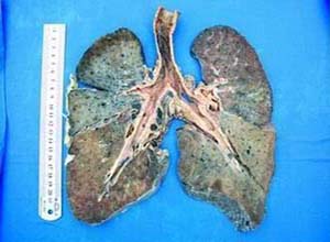 铝尘肺