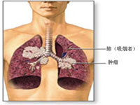 肺转移瘤