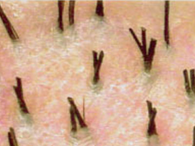 好发于头面部.皮损部丘疹长有毛发和排出皮脂样物是毛囊瘤特征.