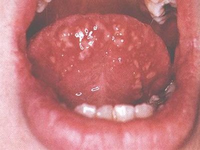 疱疹和溃疡出现在口腔黏膜,舌部,齿龈,咽部,可波及食管.