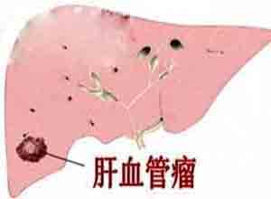 肝血管瘤