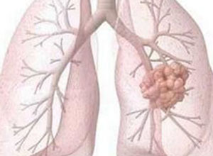 肺�Y核