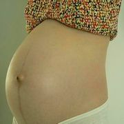 妊娠斑