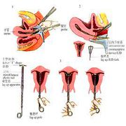 宫内节育器放置术