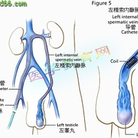 精索静脉高位结扎术