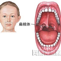 舌扁桃体