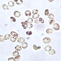尿红细胞