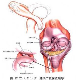 在日常生活中是比较少见的,主要症状是外侧半月板多于内侧