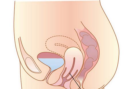 子宫脱垂发生在孕期该怎么办?