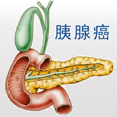 不良的饮食真的会引发胰腺癌吗?