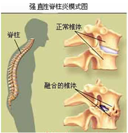 针刀治疗强直性脊柱炎(郑锦洪)