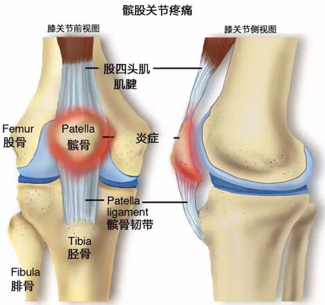 髌股关节疼痛治疗      这种疾病的治疗措施会因人而异,主要取决于