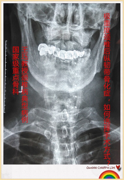 病例48:极重度颈椎后纵韧带骨化症,如何选择手术方式?