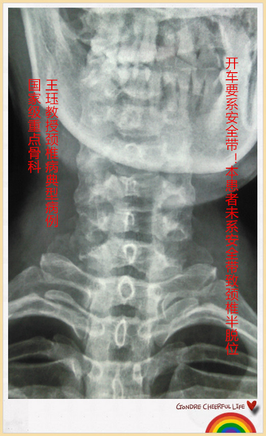 病例49:开车要系安全带!本患者未系安全带致颈椎半脱位