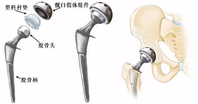 微创全髋关节置换术与传统髋关节置换术有什么不同_北京301医院蔡谞_寻医问药专家网