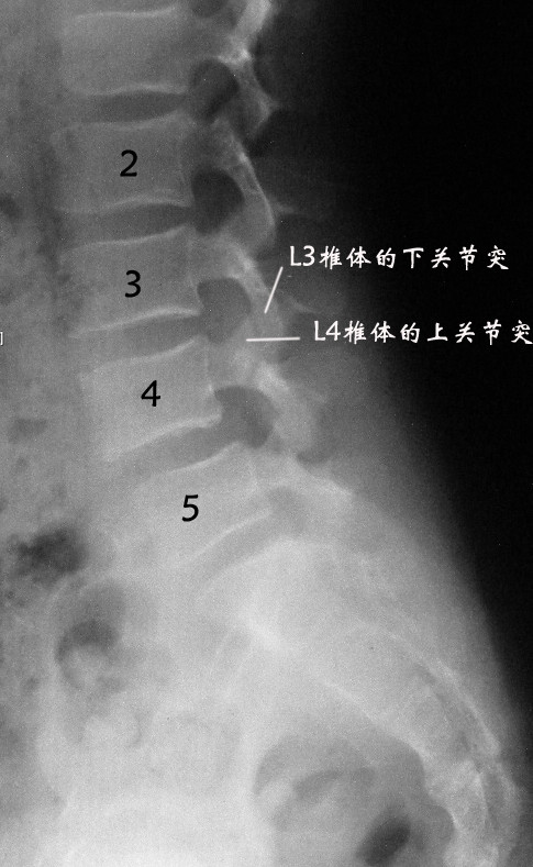 以下图为例,l3椎体的下关节突钩连l4椎体的上关节突.