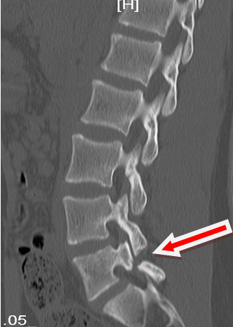 影像学资料解读:影像学检查可见l5/s1双侧椎弓峡部裂并椎体i°