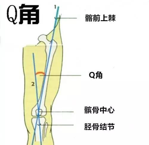 使得髋关节外翻角度大,连带到膝关节,表现为膝关节的q角很大,关节外翻