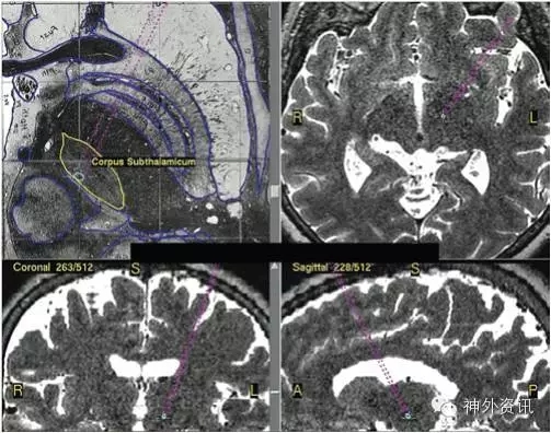 stn核的解剖和帕金森病的dbs手术治疗