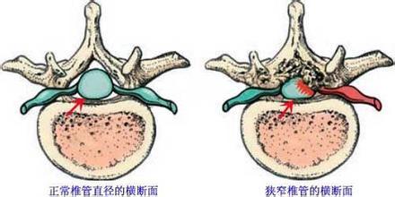 得了腰椎管狭窄后有哪些治疗方法?