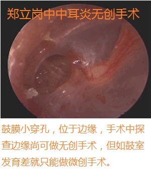慢性中耳炎无创手术第326广东佛山三水冼