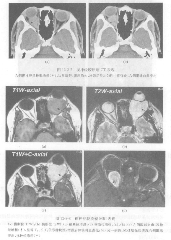 视神经胶质瘤的概述