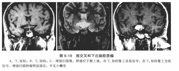 视交叉和下丘脑胶质瘤