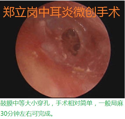 耳内镜中耳炎微创手术第375湖北荆门陈