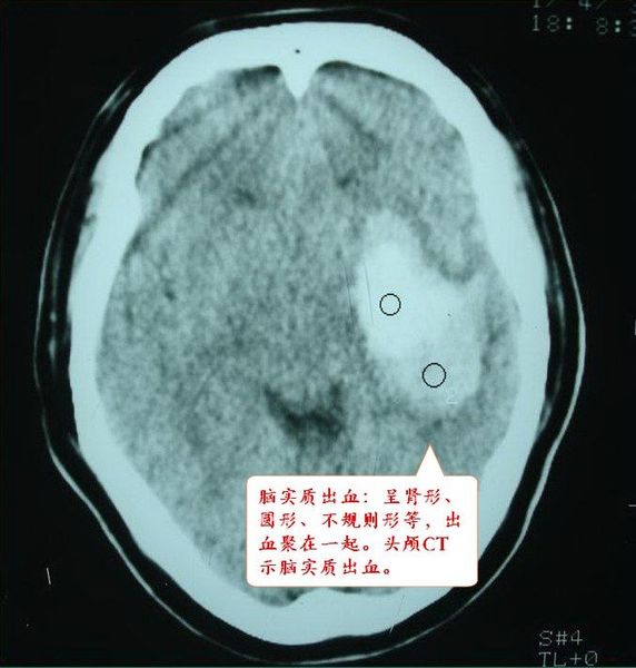 什么是蛛网膜下腔出血