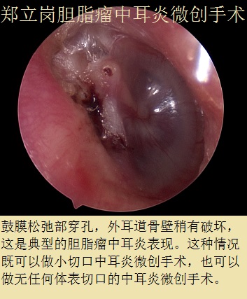 入院诊断右侧胆脂瘤型中耳炎,患者1年余前掏耳时发现右耳少量流血,伴