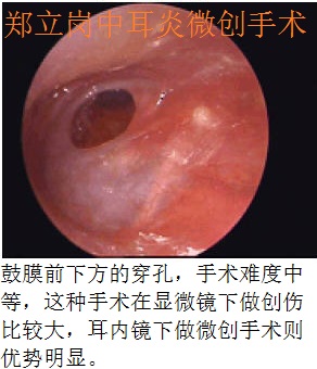 我耳朵是慢性化脓性中耳炎,流脓多年想去唐山协和医院