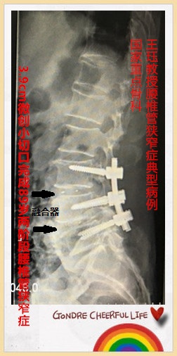 病例184:3.9cm微创小切口治疗89岁老人腰椎管狭窄症