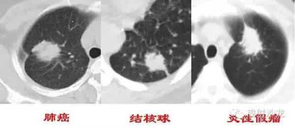 肺部硬结灶