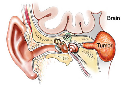 警惕听神经瘤术后并发症有哪些