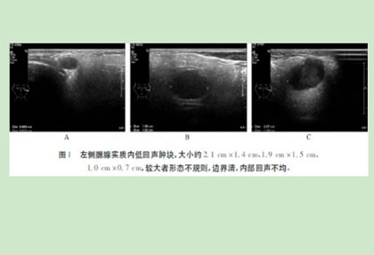 双侧腮腺腺样囊性癌1例