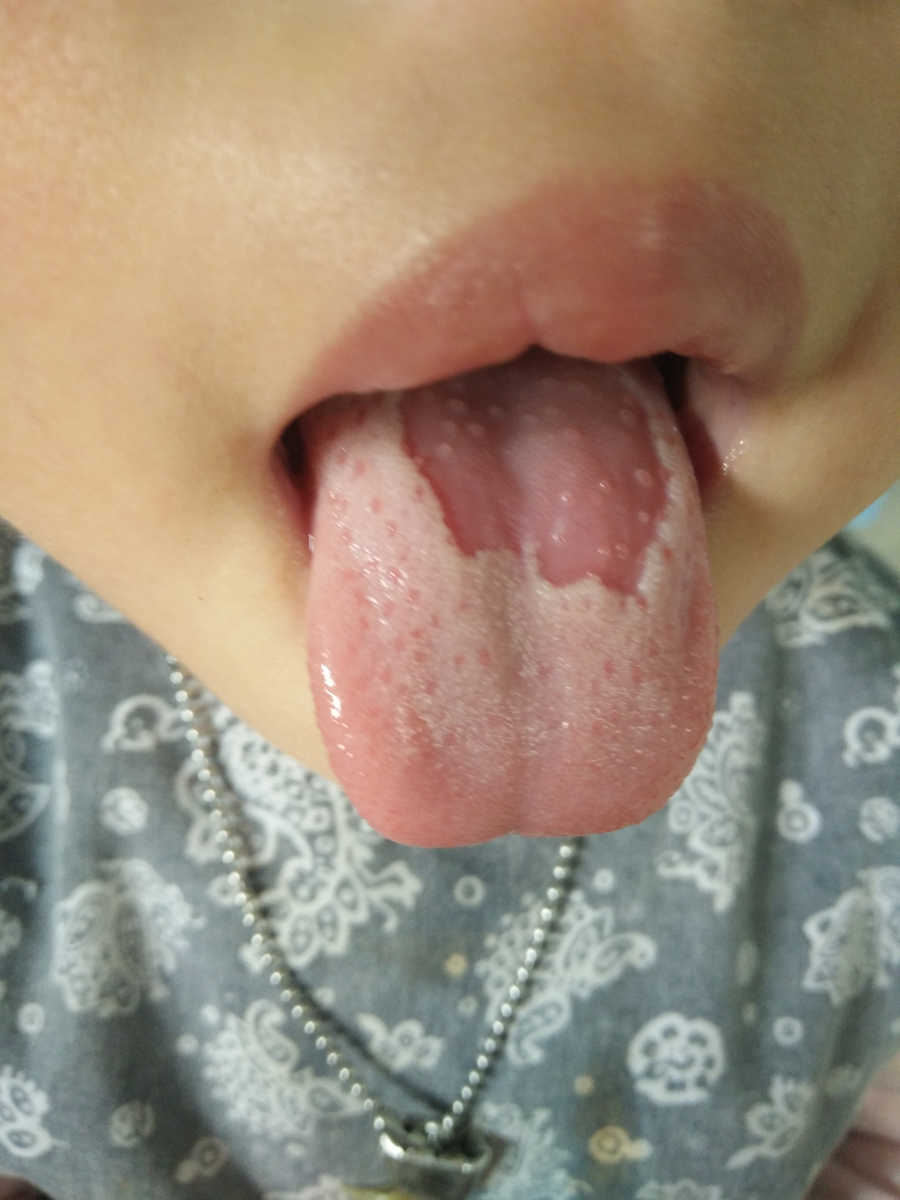 舌头发白的原因是什么