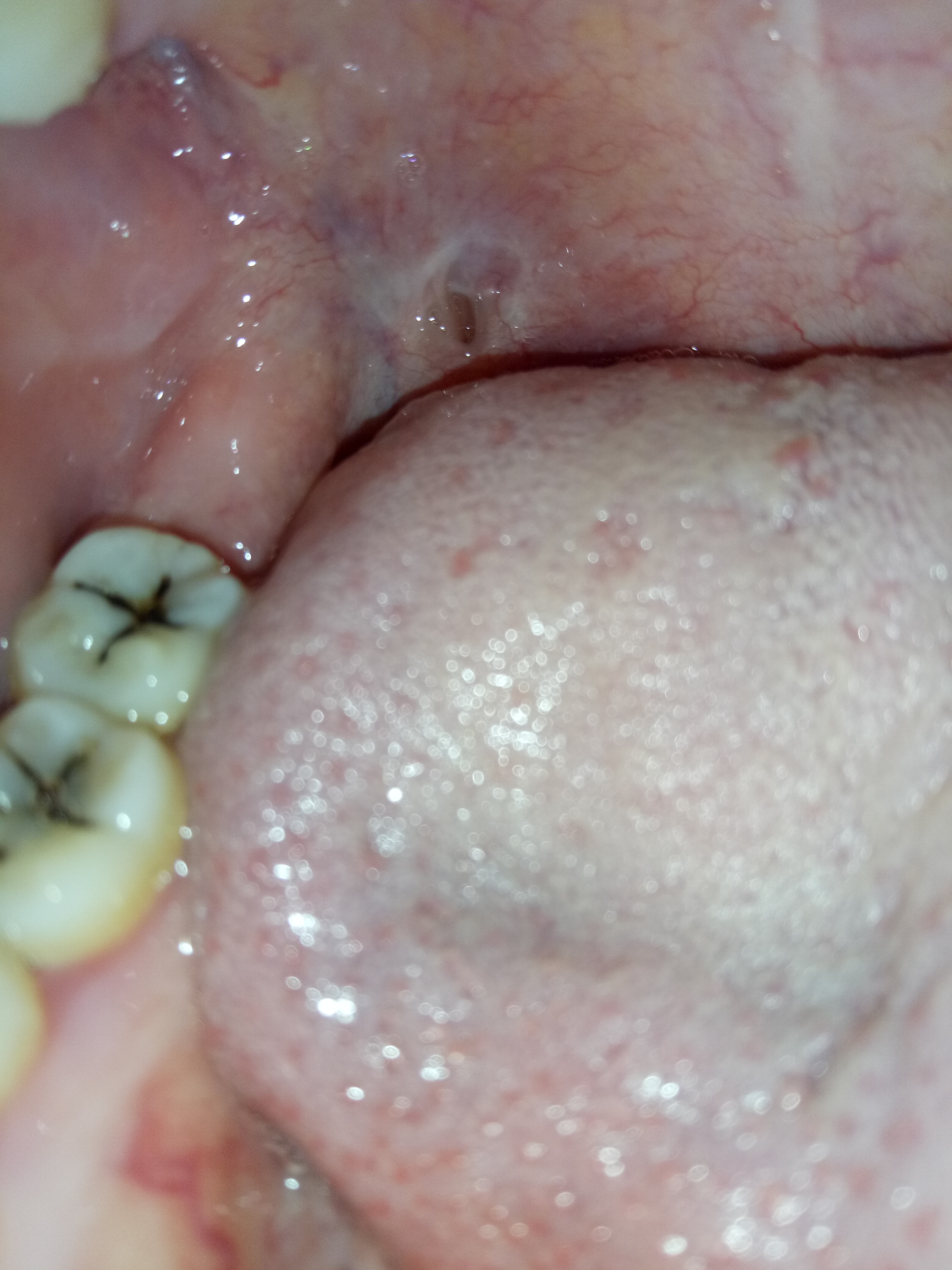 口腔内靠近喉咙那位置有个洞,不
