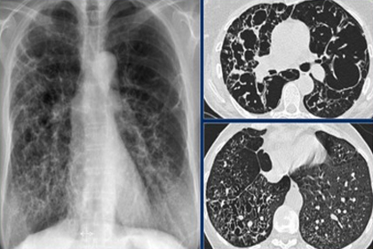 间质性肺疾病的临床特点影像学特征及病理类型分析