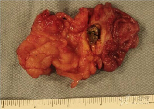 腹部 ct 可见近端胃后壁处有一肿块,胃壁呈轻度非对称性增厚(图 1