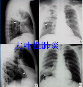 八种常见肺炎的x线诊断