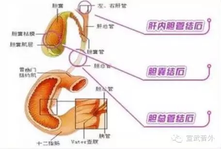 急性胆囊炎引起的疼痛,位置是在肚子右边,患者会感觉像刀割一样