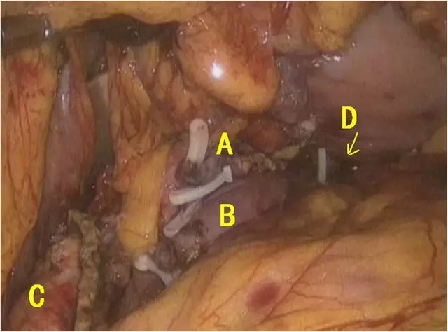 图 5 a:脾动脉;b:脾静脉;c:胰腺近端切缘;d:胰胃吻合口    手术