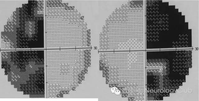 (图1:humphrey视野检测[-30db]证实双颞侧偏盲)
