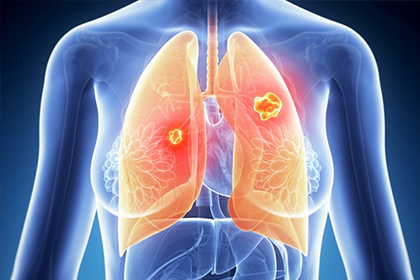 肺癌中期的症状有哪些